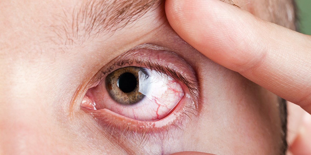 Consultați simptomele alergiilor oculare pe care trebuie să le recunoașteți