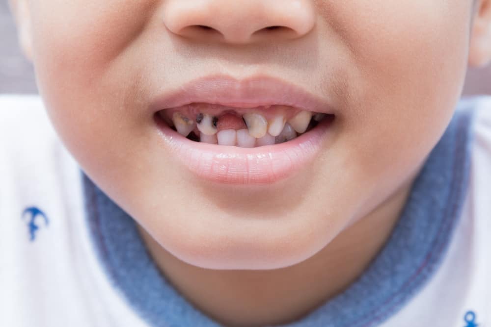 이 6가지가 어린이에게 검은 치아를 유발할 수 있습니다. 이를 방지하는 방법은 무엇입니까?
