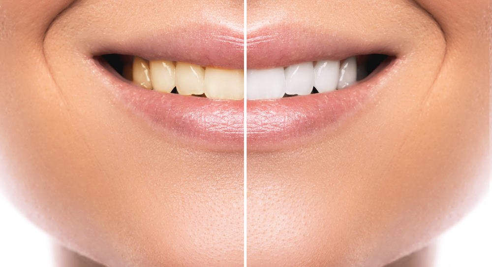 5 הרגלים שאתה הופך את השיניים שלך לא ביודעין צהובות