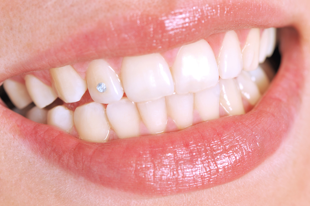 Postupci i rizici ugradnje dentalnih dijamanata