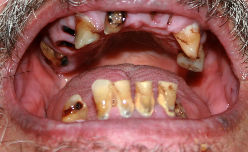 Meth Mouth (carie dentaire due à la drogue)