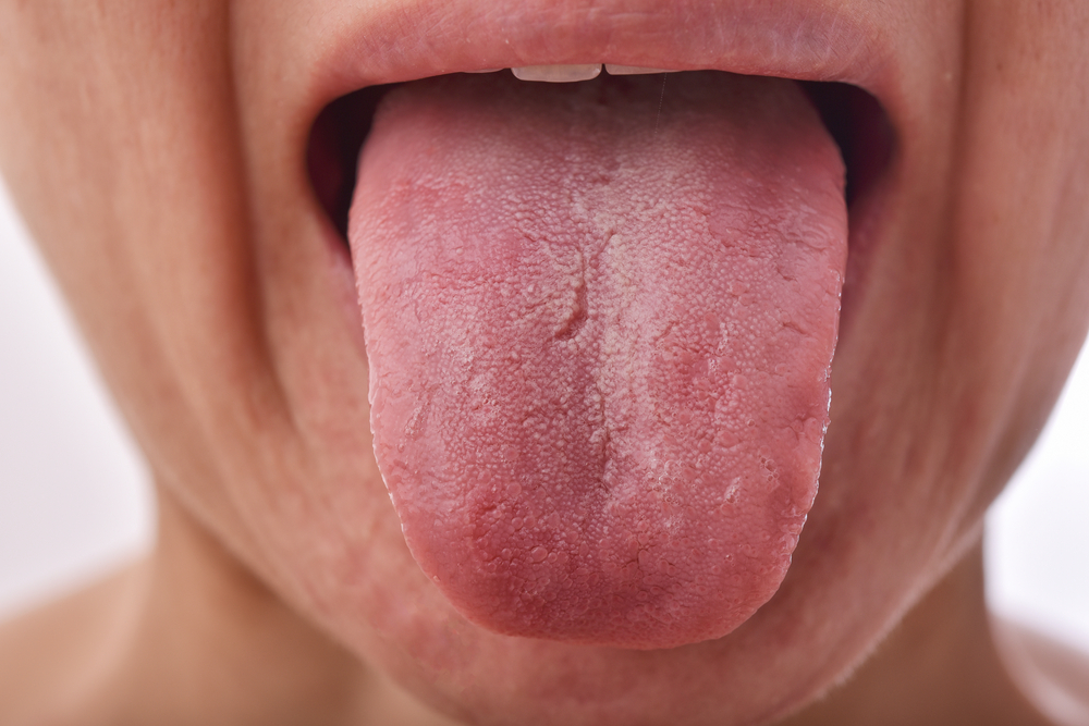Uzroci i kako prevladati ispucali jezik