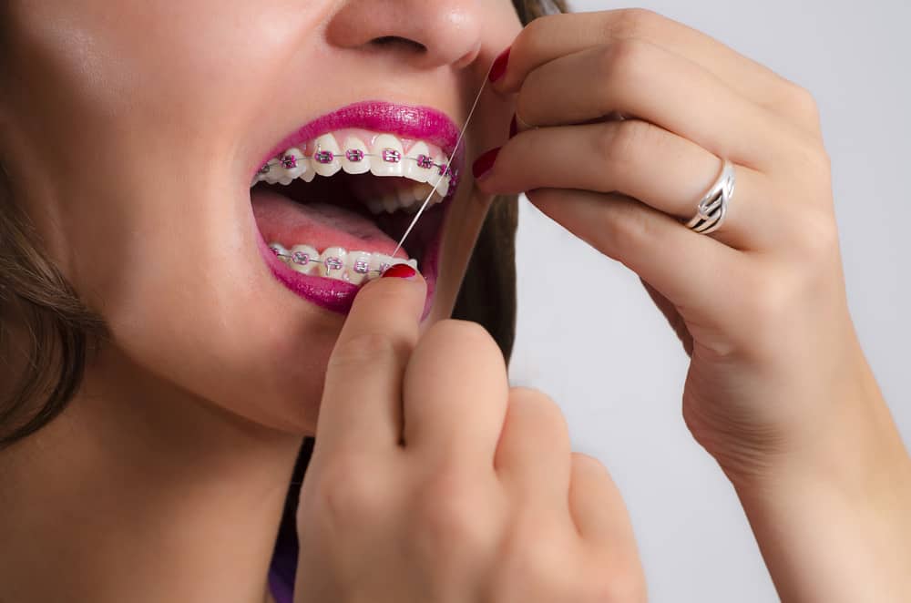 Les brosses ne suffisent pas, le fil dentaire doit être utilisé par les utilisateurs d'appareils orthodontiques