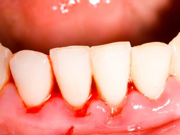 5 tipuri de alimente pentru a trata gingiile care sângerează