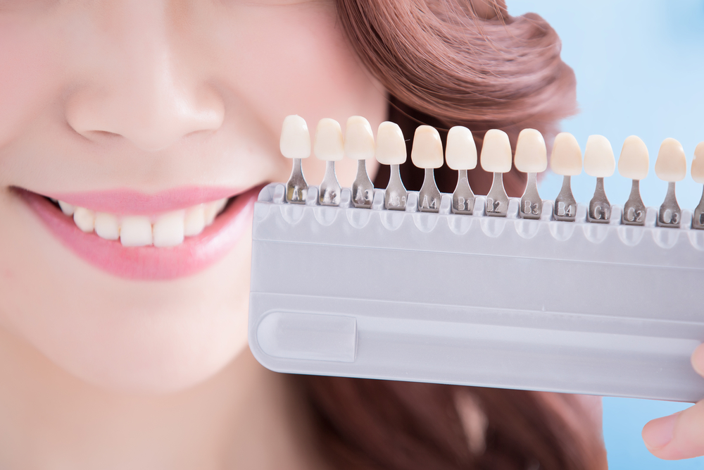 כמה זמן יכולות להימשך ההשפעות של הלבנת שיניים אצל הרופא?