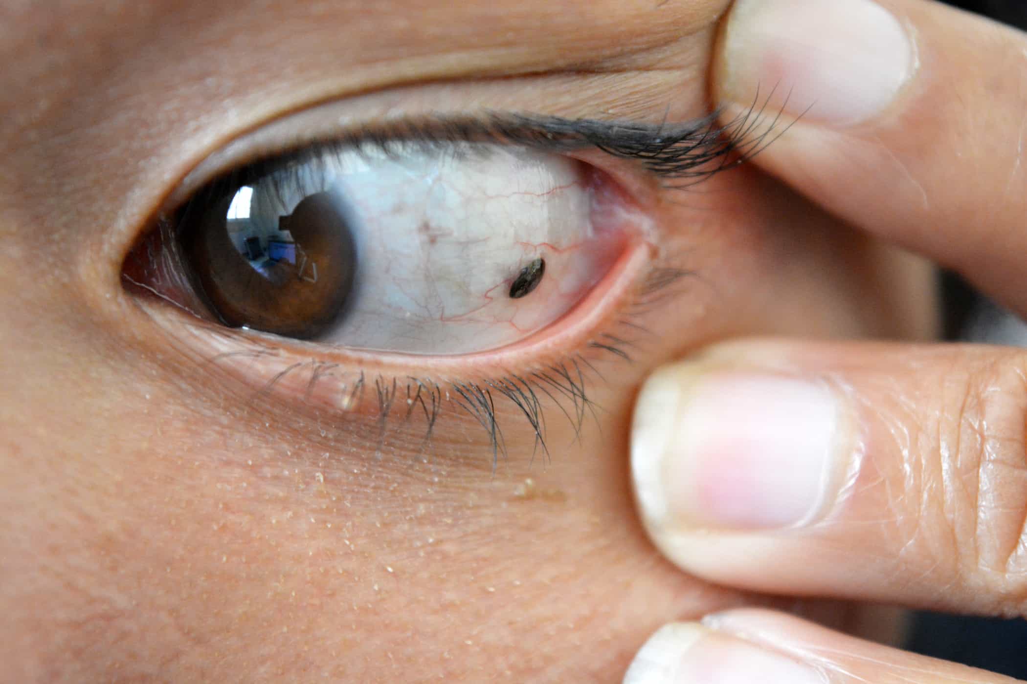 Non seulement attaque la peau, le cancer du mélanome peut également apparaître dans les yeux
