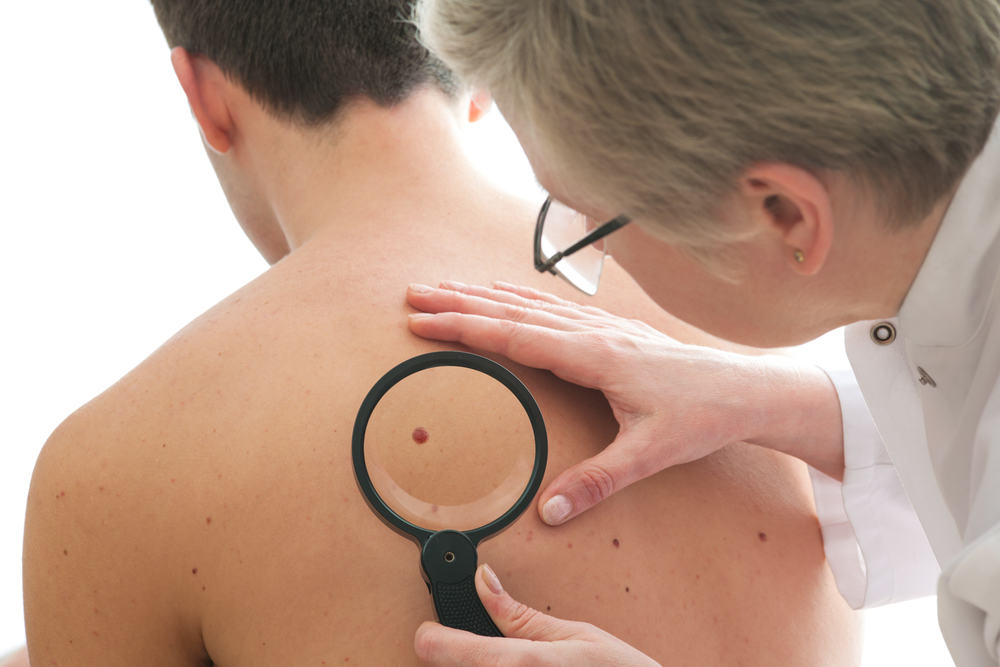 Prepoznavanje razlike između simptoma melazme i melanoma