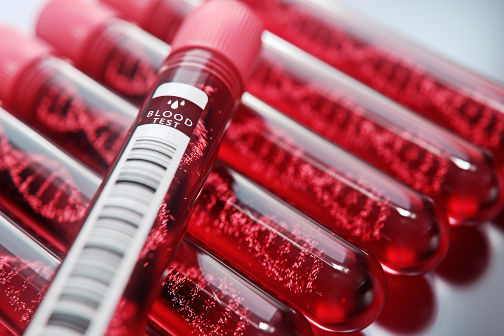 Teste pentru diagnosticarea anemiei falciforme