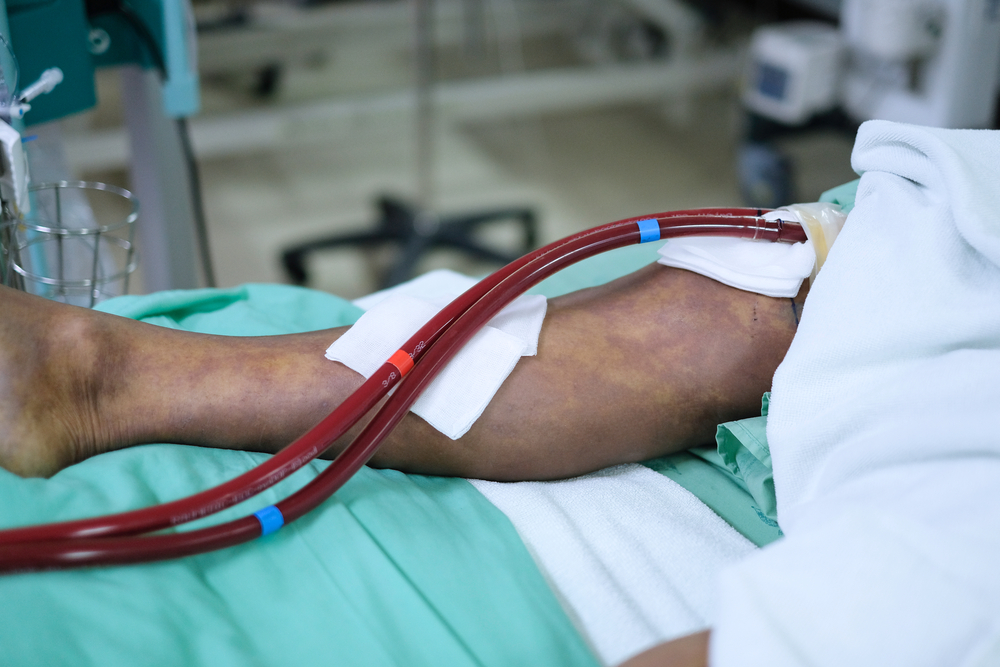 Prepoznavanje kritične ishemije ekstremiteta (CLI), komplikacije bolesti perifernih arterija