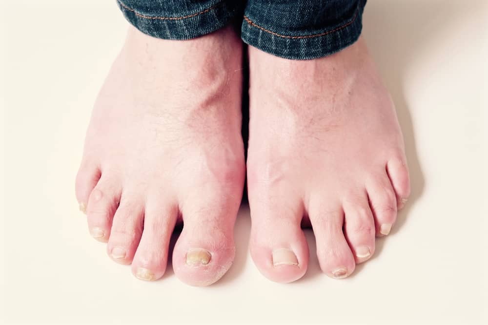 3 najčešća uzroka debelih noktiju na nogama, plus savjeti za njihovo prevladavanje