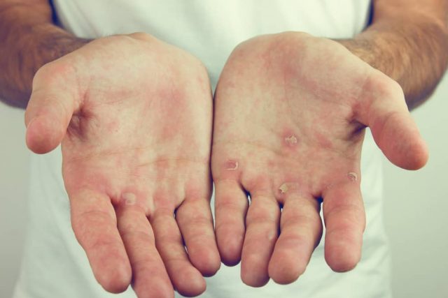 4 sätt att övervinna förhårdnader på händerna så att de inte dyker upp igen