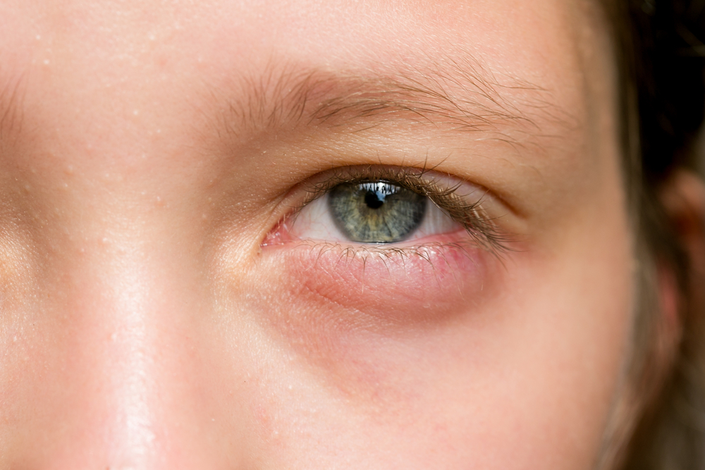 갑상선종은 또한 눈을 부을 수 있습니다.