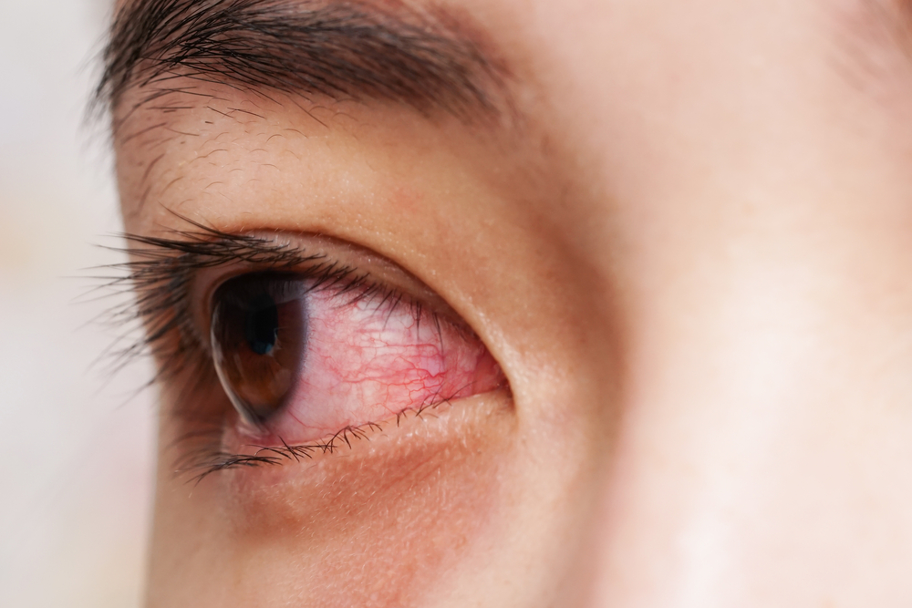 Épisclérite, inflammation légère du tissu du globe oculaire due à certaines conditions