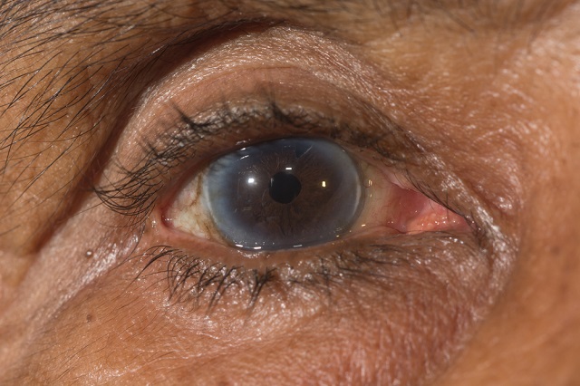 Iridotomija, postupak prevencije glaukoma zatvorenog kuta