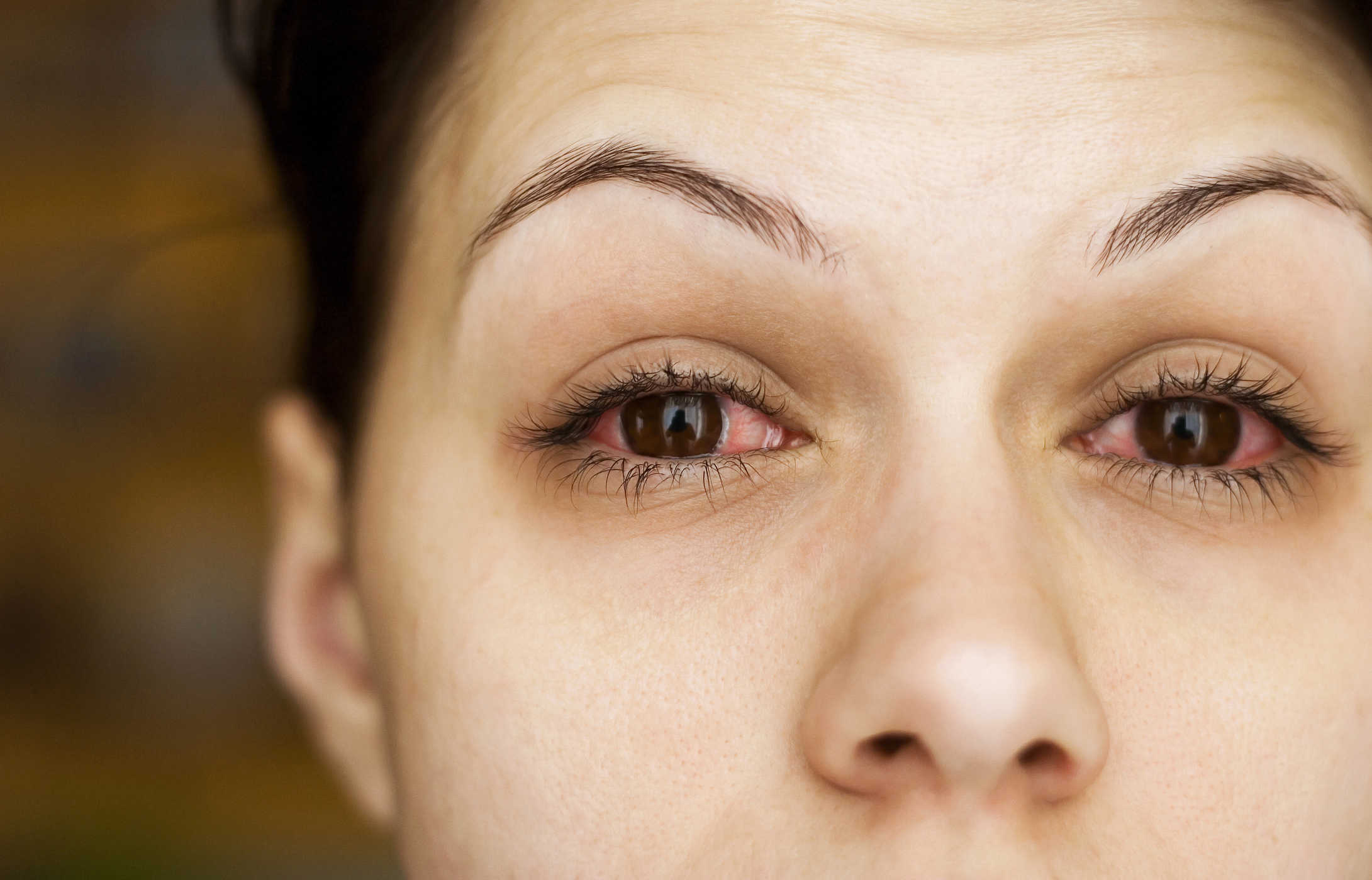콘택트 렌즈 사용으로 인한 눈 감염 인식