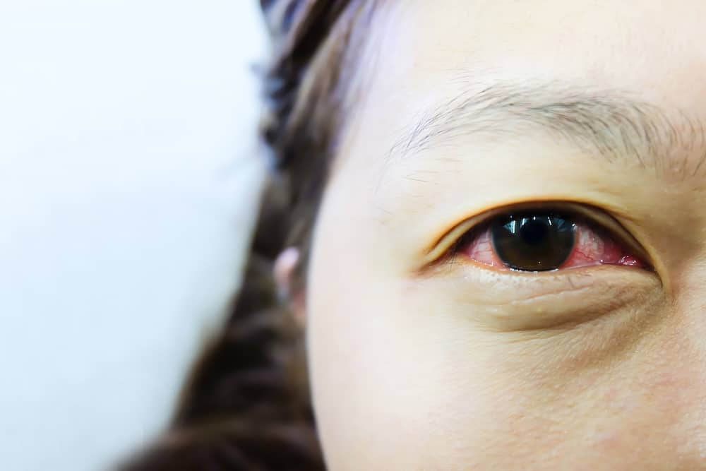 האם זה נכון שכאבי עיניים אדומות יכולים להיות מועברים מהמבט? בדוק את העובדות כאן!