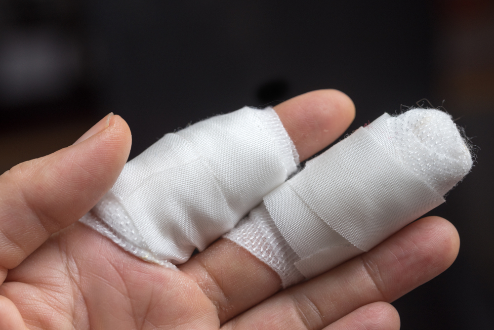 Kann ein gebrochener Finger wieder befestigt werden?