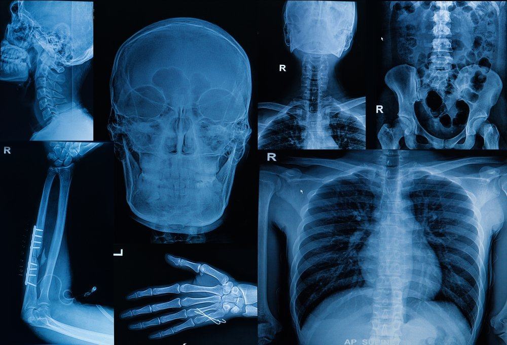 Reconnaître les quatre types rares de maladies osseuses