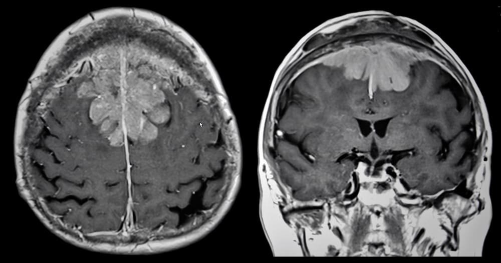 Vrste i simptomi tumora mozga koje biste trebali znati