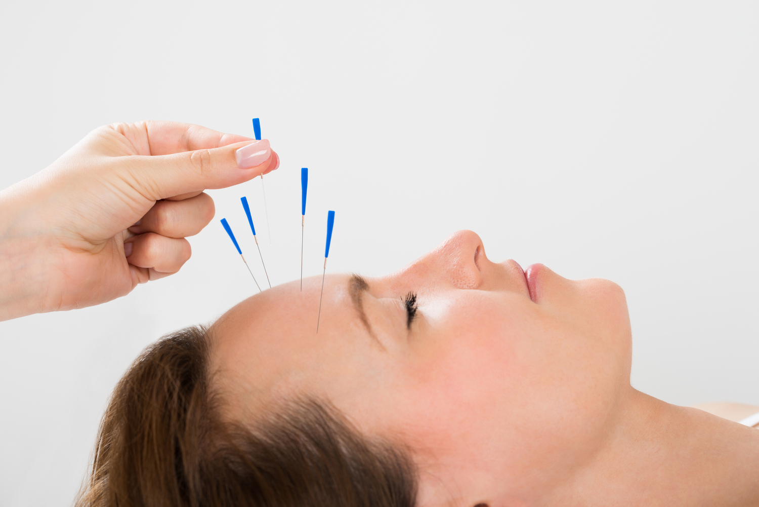 Acupunctura poate ameliora durerile de cap și migrenele