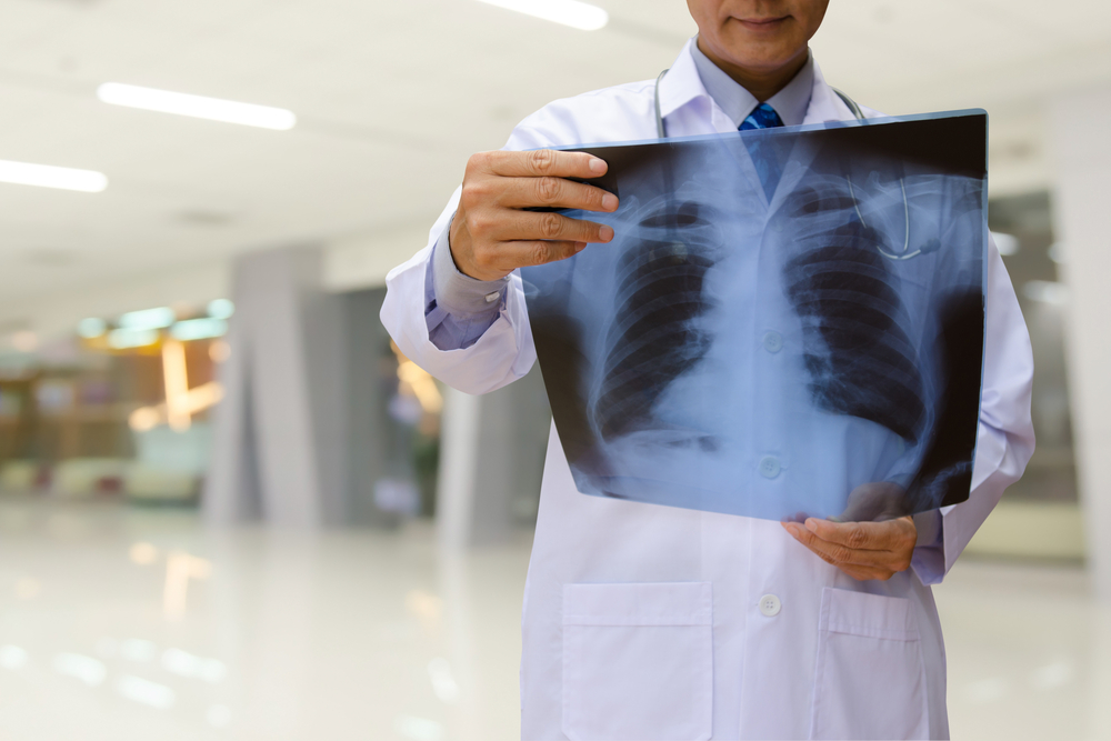 Prepoznajte simptome, uzroke i liječenje restriktivne plućne bolesti