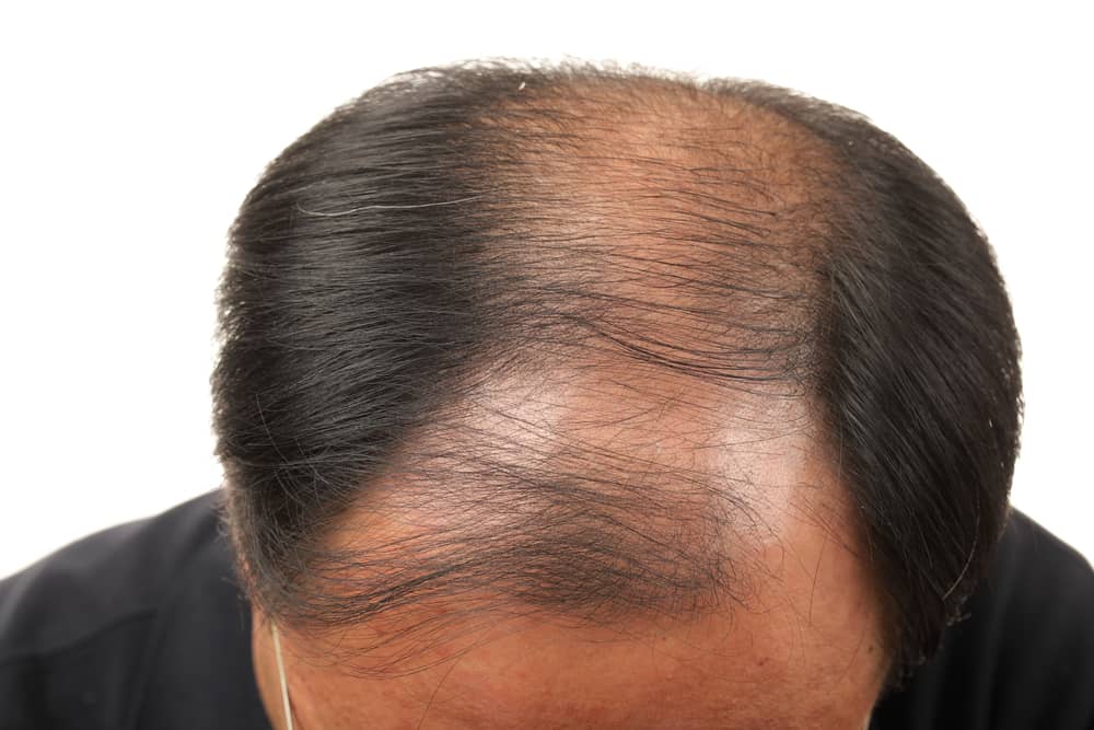 Est-il vrai que la masturbation fréquente provoque la chute des cheveux ?