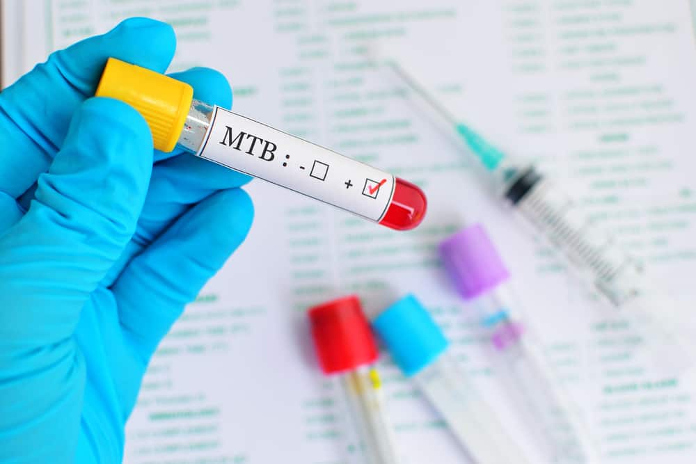 Почему пациенты с ВИЧ / СПИДом (ЛЖВС) должны немедленно проходить тестирование на туберкулез?
