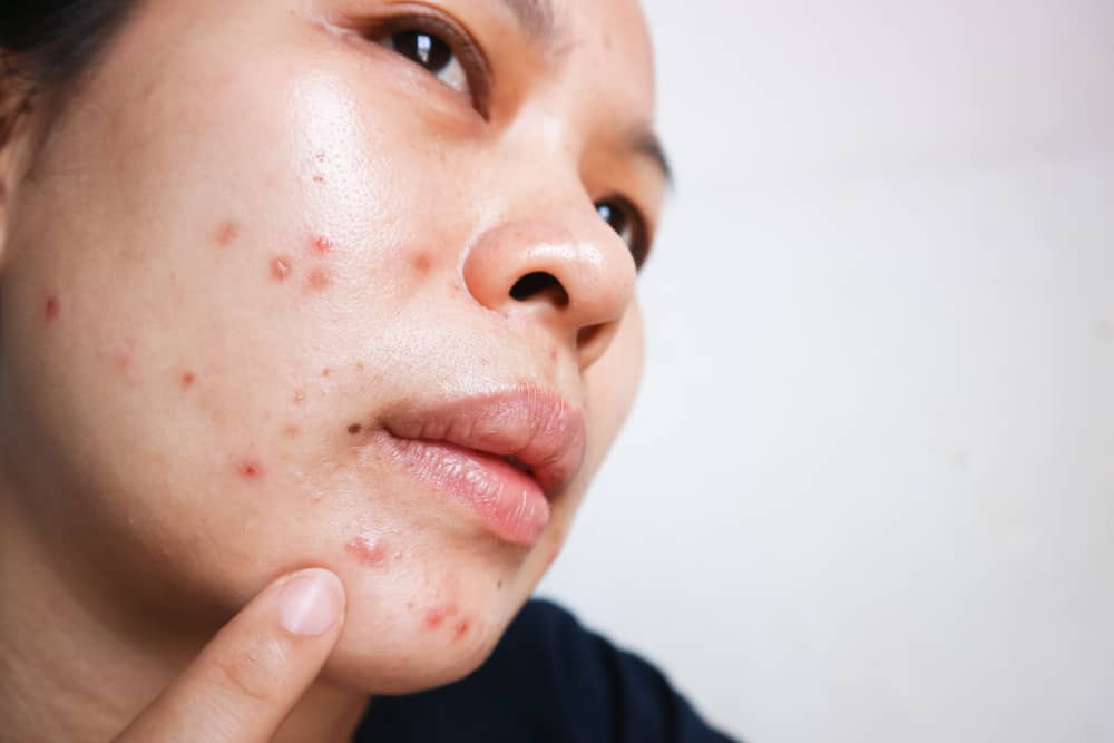 Pourquoi l'acné apparaît toujours avant la menstruation ?