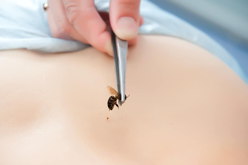 La terapia indiscriminada de picadura de abeja para tratar el reumatismo puede ser fatal