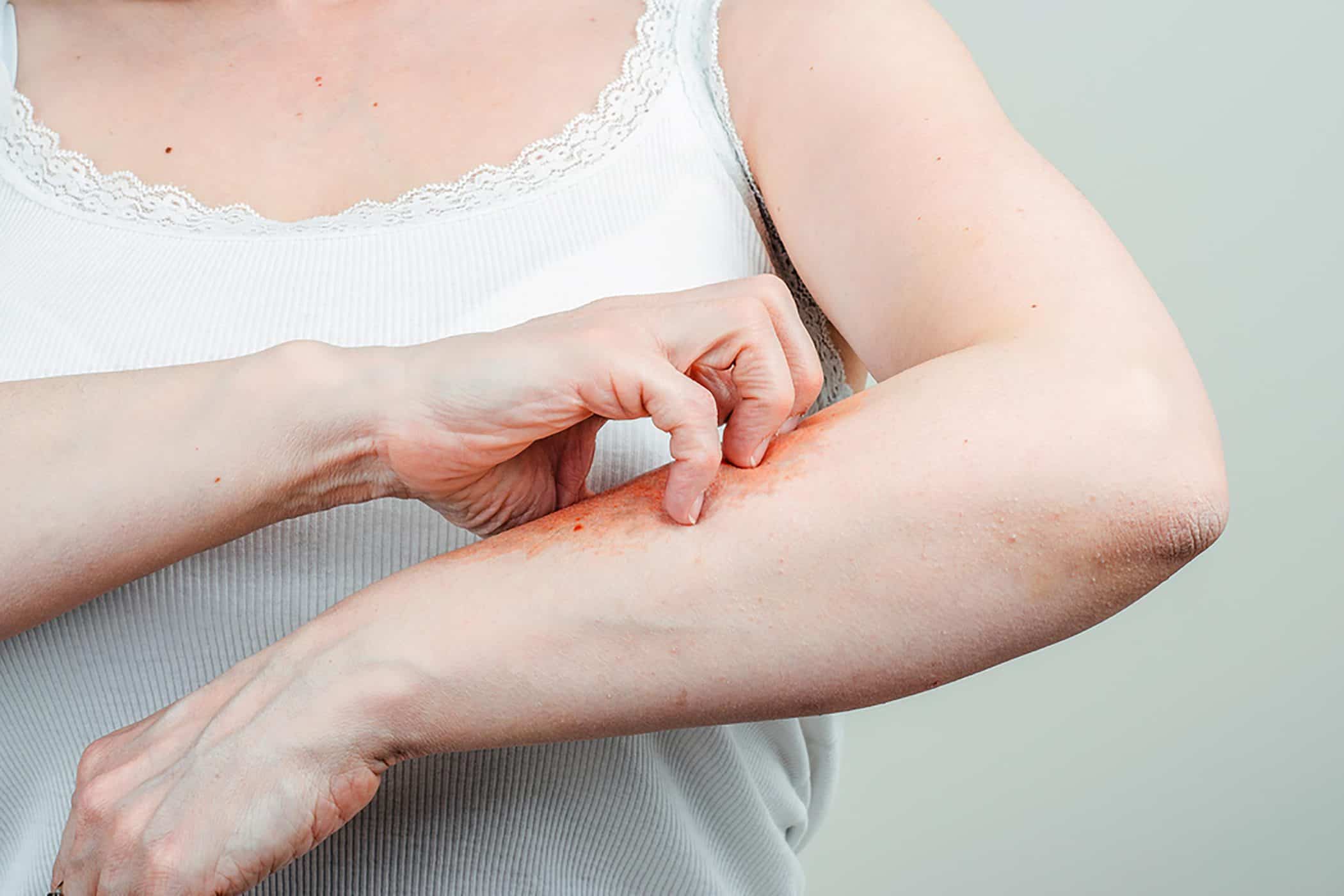 Hören Sie mit diesen 9 Tipps auf, juckende Haut zu kratzen