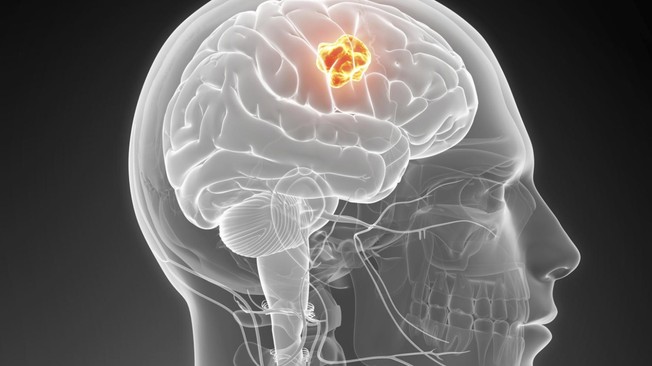 Är alla hjärntumörer dödliga?