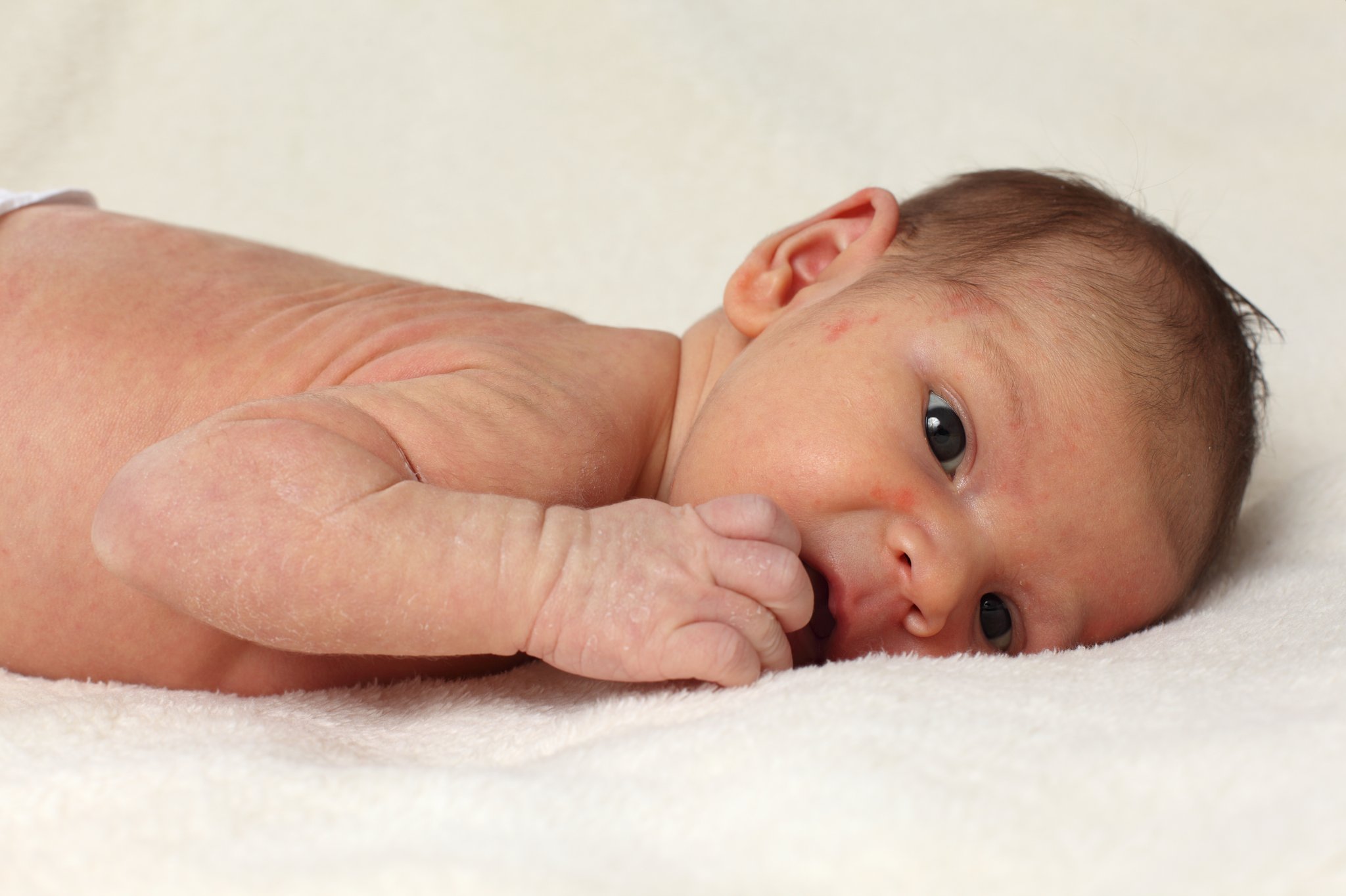 Les bébés ont souvent de l'eczéma ? Peut-être que la nourriture de la mère est la cause