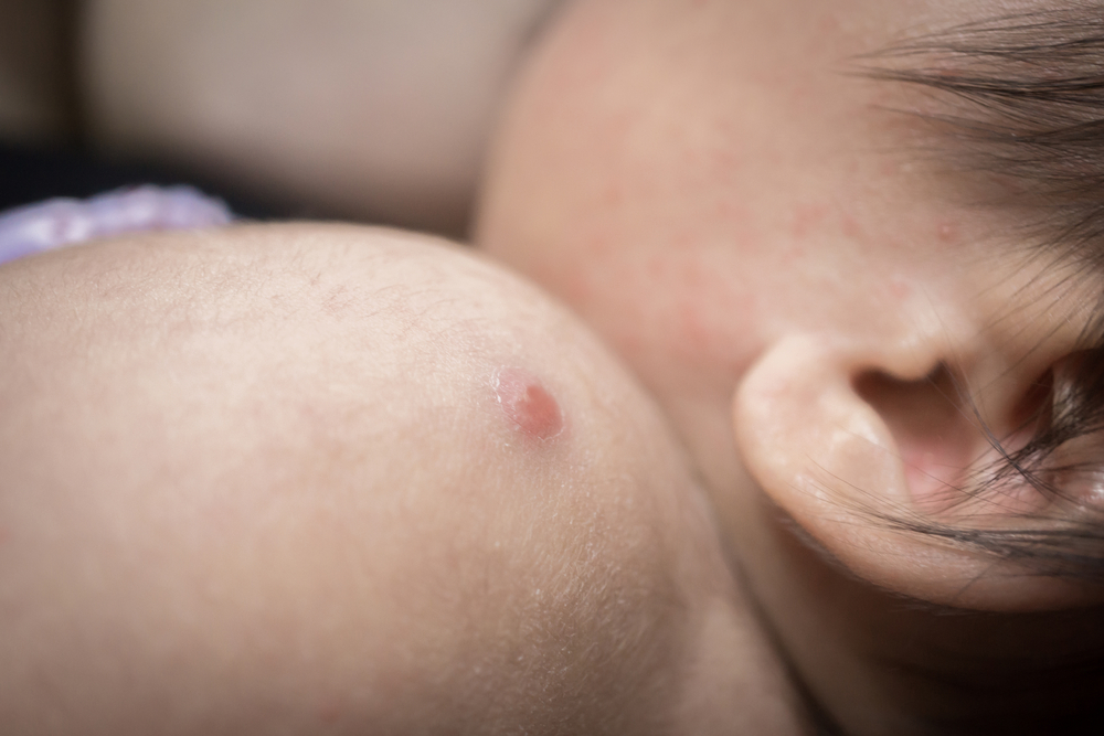 Est-il normal que des furoncles apparaissent après la vaccination par le BCG ?