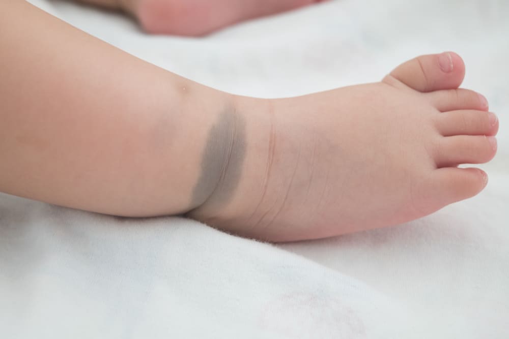 Taches de naissance de couleur foncée sur les fesses ou le dos de bébé, que signifient-elles ?