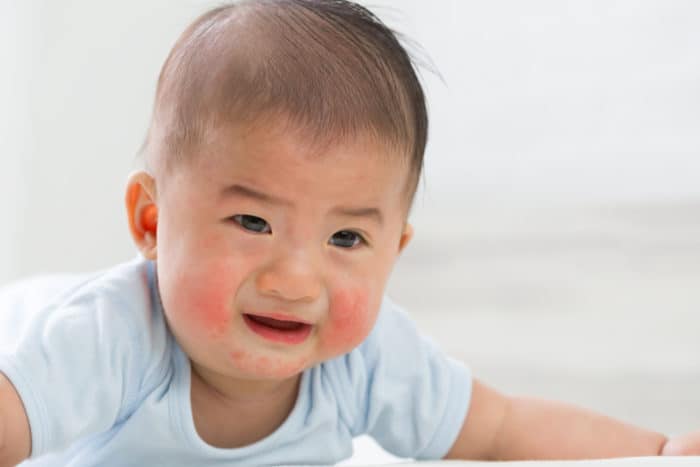 Caractéristiques de l'eczéma chez les bébés selon le développement de l'âge