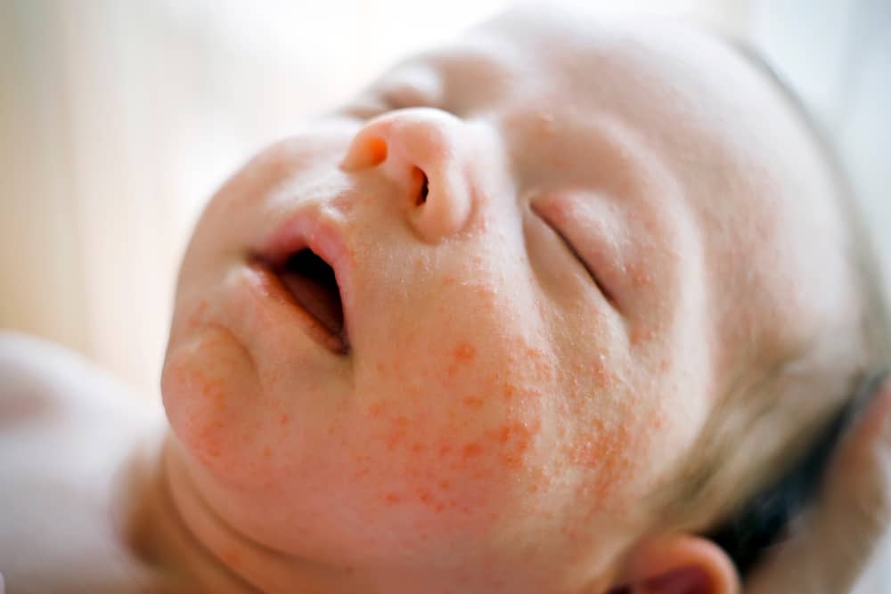 Taches blanches sur le visage de bébé, dues à l'acné ou à la milice ? Voici 3 façons de faire la différence