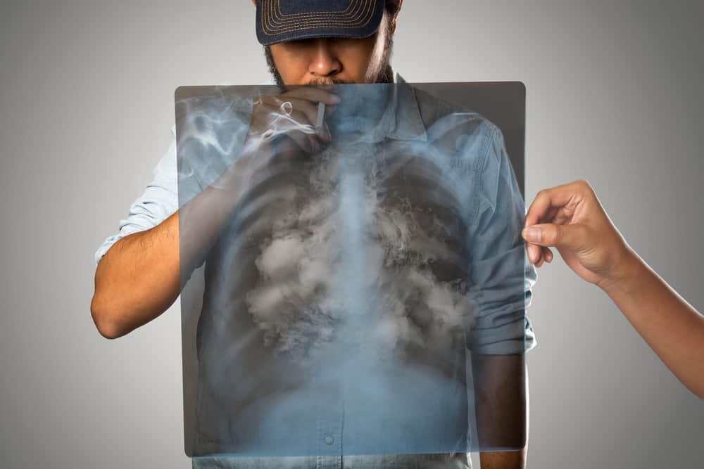 5 efforts efficaces de prévention du cancer du poumon
