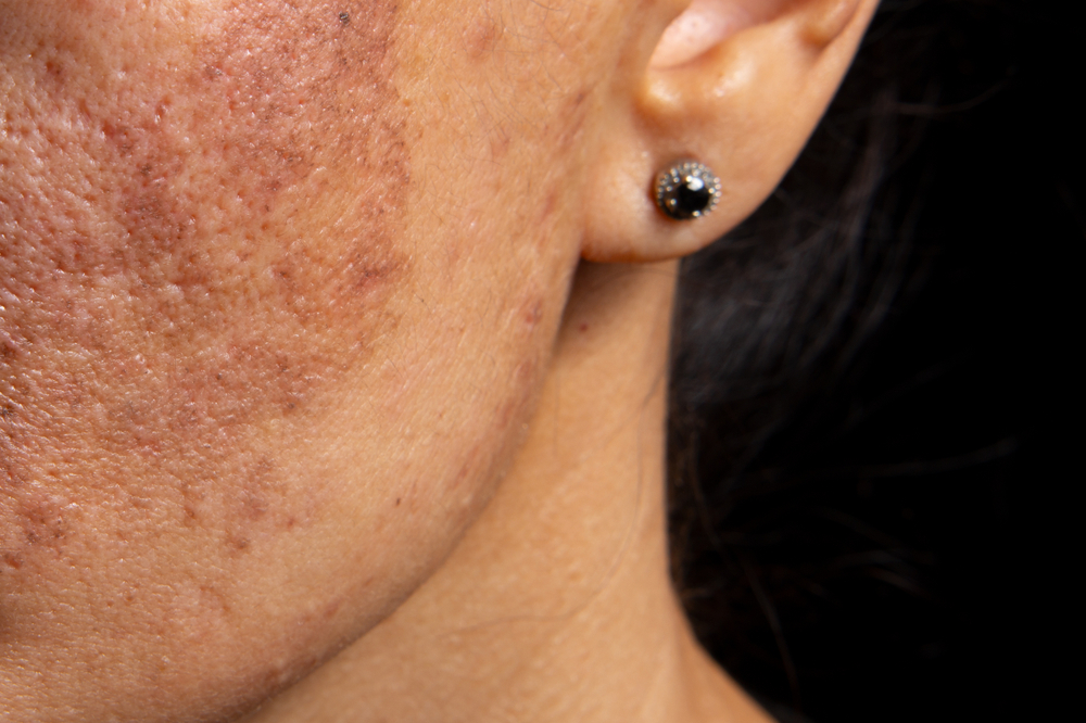 Varför uppstår svart hud hos patienter med njursvikt?